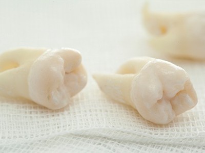 智齒疼了，這牙非拔不可嗎？