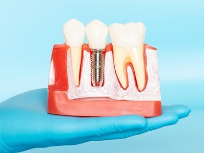 種牙VS鑲牙，你適合哪種?