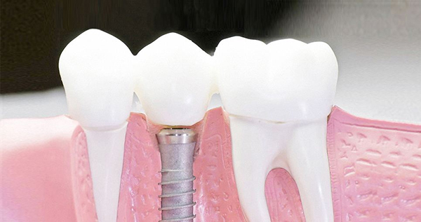 在承德口腔種植牙齒需要多少錢？惟德口腔一一為您道來